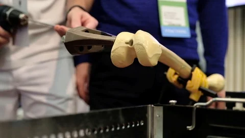 Doctors installing titanium rods in the bones Stock Footage 89567421