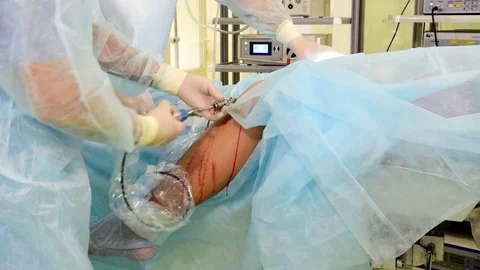 Doctors made a puncture of the knee joint Stock Footage 99552188
