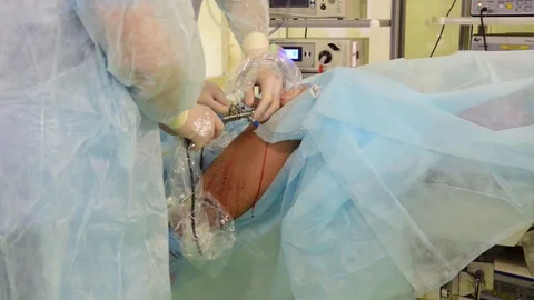 Doctors made a puncture of the knee joint Stock Footage 99552421
