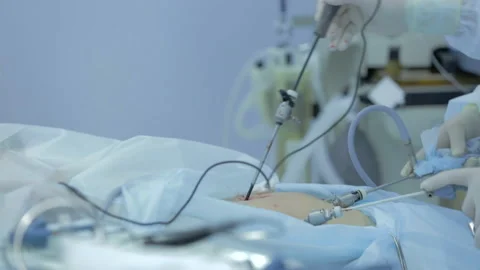 Doctors in operating room carry out real endoscopic operation, patient’s body Video stock 132740922