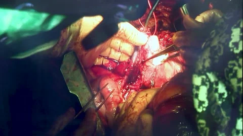 Doctors perform abdominal surgery. Shooting from monitor. Contains reflections. Stock Footage 148148574