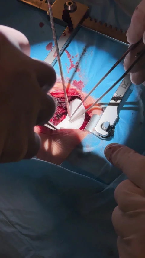 Doctors perform a complex operation on a person's spine. Stock Footage 320547485