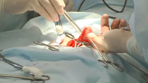 Doctors perform surgery, surgery, medicine. Stock Footage 101347080