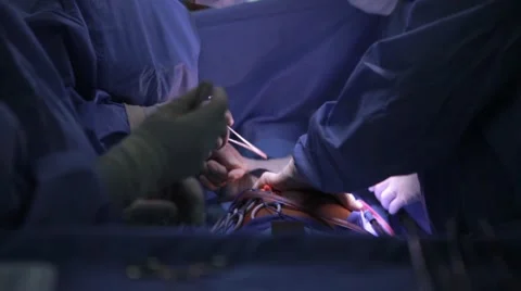 Doctors performing operation in operation theatre Stock Footage 62389075