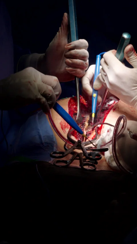 Doctors performing real spine surgery Stock Footage 317680300