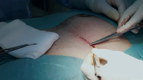 Doctors Performing Surgery in Operating Room. Stock Footage 91858096