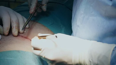 Doctors Performing Surgery in Operating Room. Stock Footage 91858408
