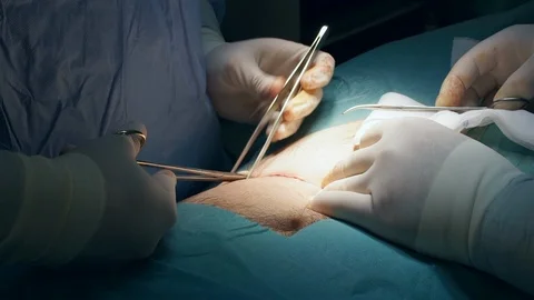 Doctors Performing Surgery in Operating Room. Stock Footage 91858622
