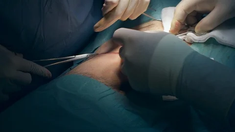 Doctors Performing Surgery in Operating Room. Stock Footage 91859209