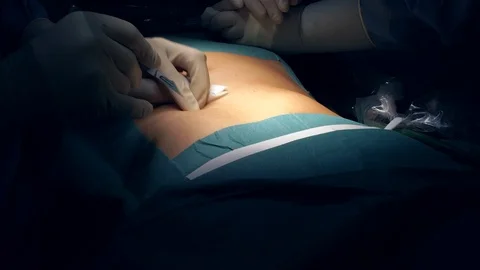 Doctors Performing Surgery in Operating Room. Stock Footage 92119278