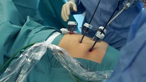 Doctors Performing Surgery in Operating Room. Stock Footage 92121931