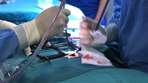 Doctors Performing Surgery in Operating Room. Stock Footage 92129760