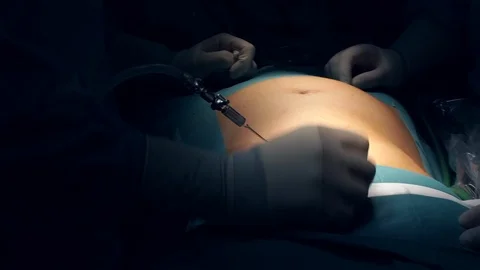 Doctors Performing Surgery in Operating Room. Stock Footage 92158200