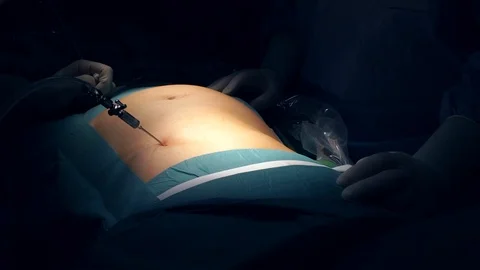 Doctors Performing Surgery in Operating Room. Stock Footage 92158211