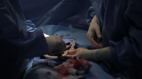 Doctors performing surgery on a patient Stock Footage 62389018