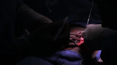 Doctors performing surgery on a patient Stock Footage 62389033