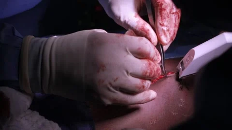 Doctors performing surgery on a patient Stock Footage 62389051