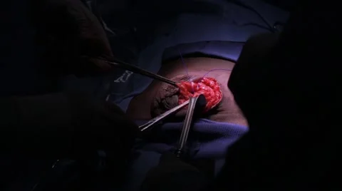 Doctors performing surgery on a patient Stock Footage 62389057