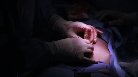 Doctors performing surgery on a patient Stock Footage 62389060