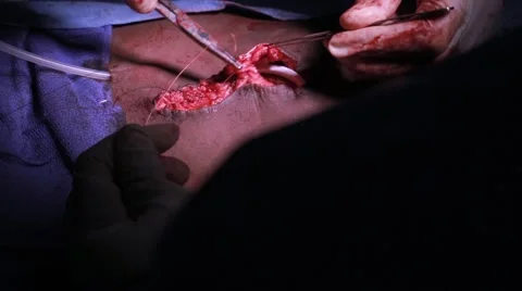 Doctors performing surgery on a patient Stock Footage 62389069