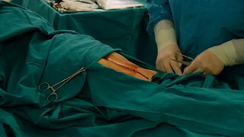 Doctors prepare the patient for surgery Stock Footage 90819541