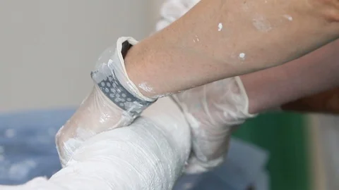 Doctors put a plaster cast. Stock Footage 111951607