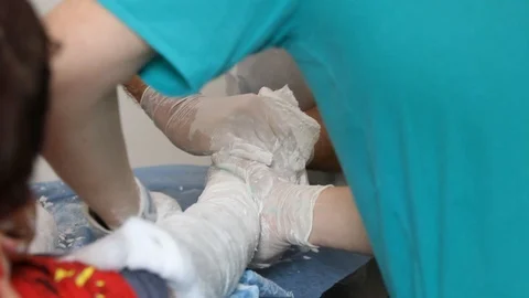Doctors put a plaster cast. Stock Footage 111951616