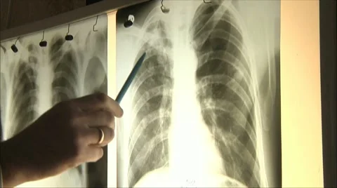 Doctors regard chest x-ray Stock Footage 10590014