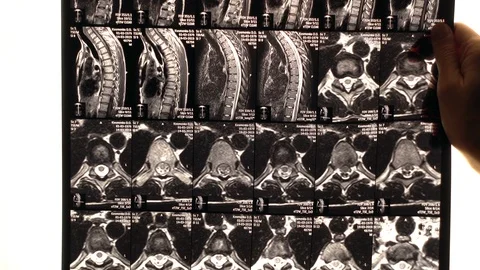 The doctor's see problem areas of the back on the MRI Scan or X-Ray Stock Footage 106443681