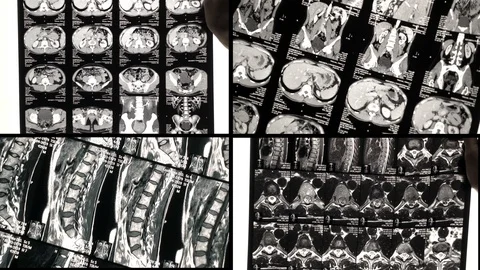 The doctor's see problem areas of the back on the MRI Scan or X-Ray. Stock Footage 106501414