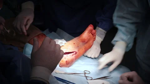 Doctors sew up the incision with threads after the operation. Stock Footage 238026601