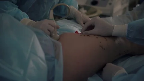 Doctors surgeons do surgery on the leg with special equipment in the operating Stock Footage 126746623