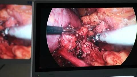 Doctors use endo-instruments and video cameras to perform surgery Stock Footage 132762857