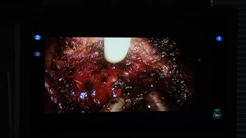 Doctors use endo-instruments and video cameras to perform surgery Stock Footage 256588330