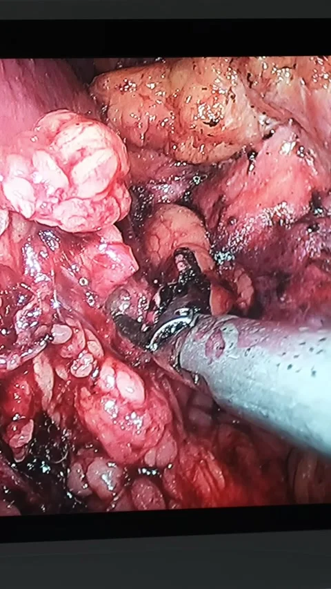 Doctors use endo-instruments and video cameras to perform surgery in the ab.. Stock Footage 291948550