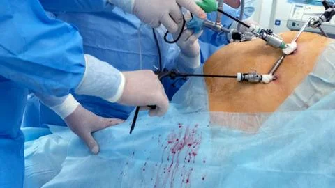 Doctors use endo-instruments and video cameras to perform surgery in the Stock Photos