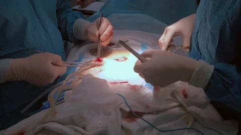 Doctors use medical instruments and metal thread to suture human skin. Stock Footage 150908016