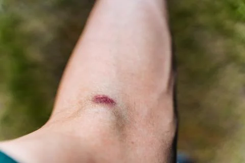 Documenting the gradual healing process of a bruise on the arm, this closeu.. 库存照片