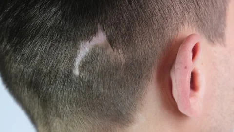 A dog bite scar on a mans head Stock Footage 321797923