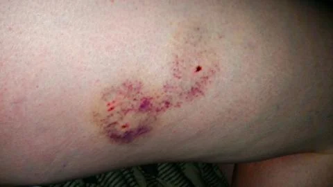 Dog Bite Wound Stock Photos