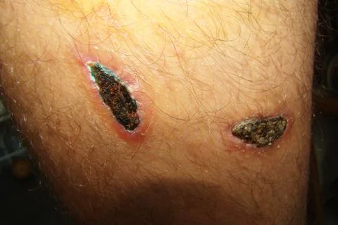 Dog bite wound Stock Photos