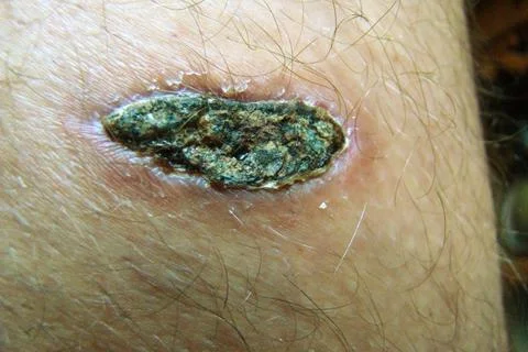 Dog bite wound Stock Photos