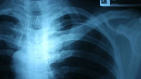 Dolly shot of x-ray image Stock Footage 30480659