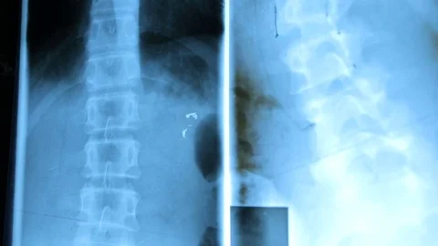 Dolly shot of x-ray image Stock Footage 74593566