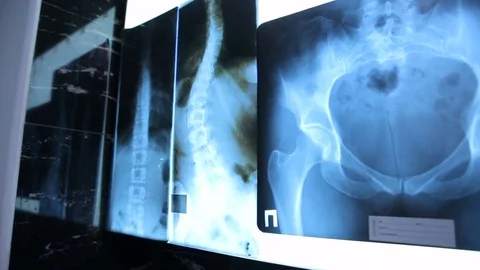 Dolly shot of x-ray image Stock Footage 74593614