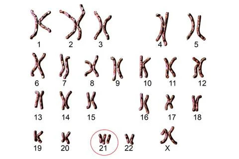 Down's syndrome karyotype, illustration Ilustração Stock