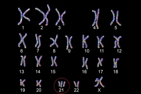 Down's syndrome karyotype, illustration Ilustração Stock