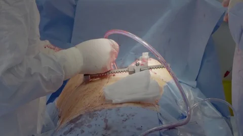 Drainage of blood flow during the operation Video stock 104924398