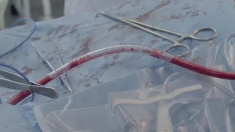 Drainage of blood flow during the operation Video stock 104924406