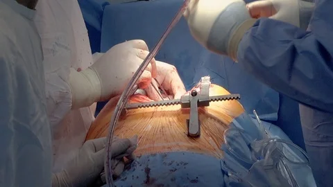 Drainage of blood flow during the operation. Close-up Stock Footage 104924537